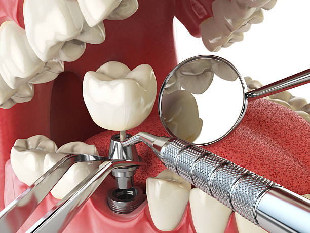 Best Emergency Dentist for Lost Fillings or Crowns in Salem, OR